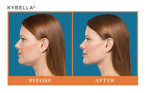 How Kybella Can Help You Say Goodbye to Your Double Chin blog