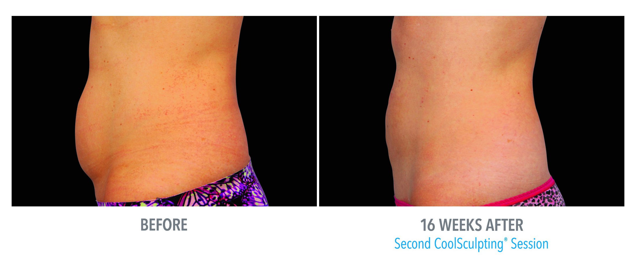 Coolsculpting Before and After Feature 1