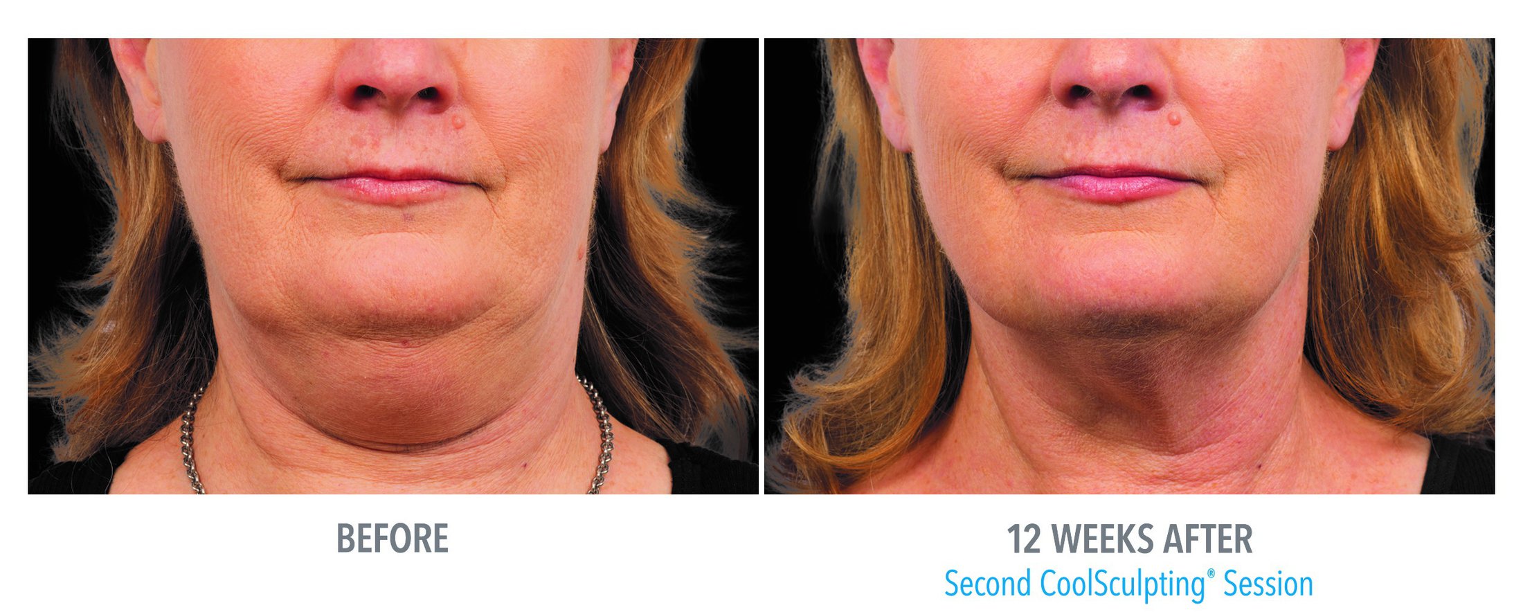 Coolsculpting Before and After Feature 3