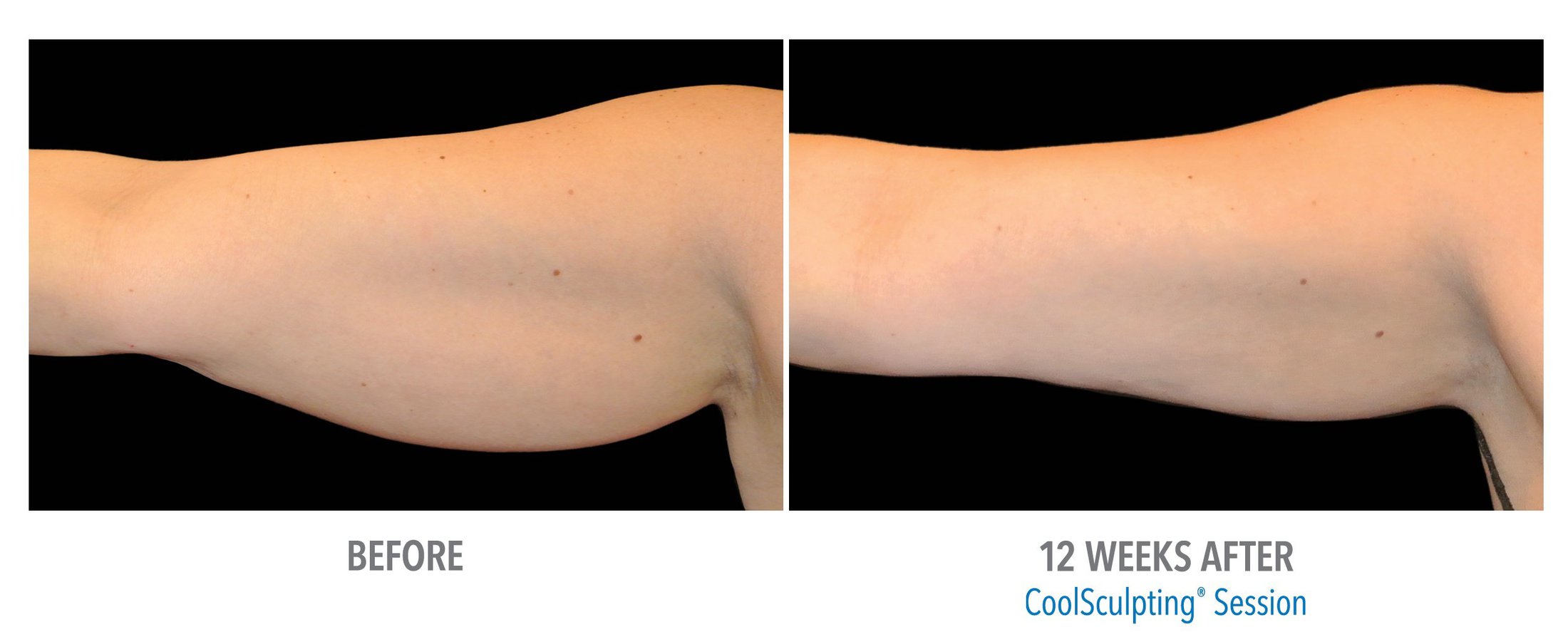 Coolsculpting Before and After Feature 4