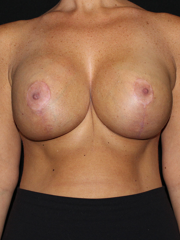 Breas Implant Exchange Before & After Image