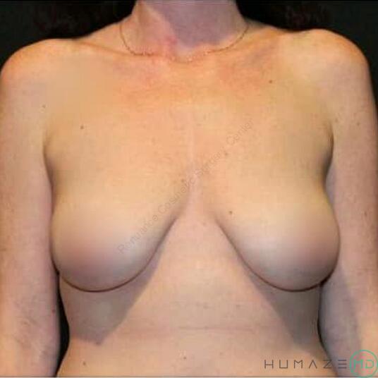 Breast Lift with Implants Before & After Image