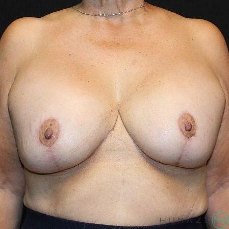 Breast Lift with Implants Before & After Image