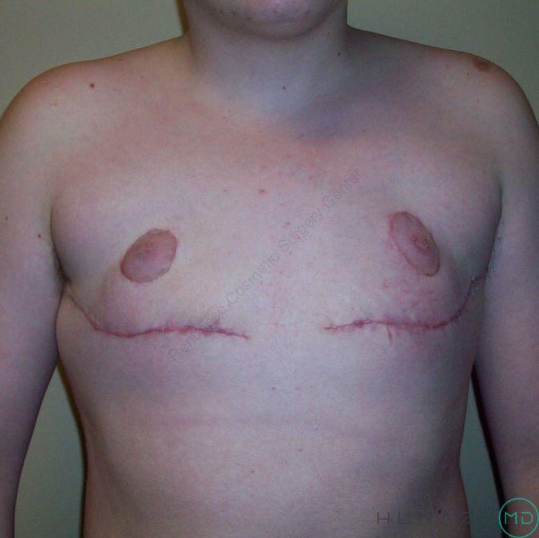 FTM Chest Masculinization Before & After Image