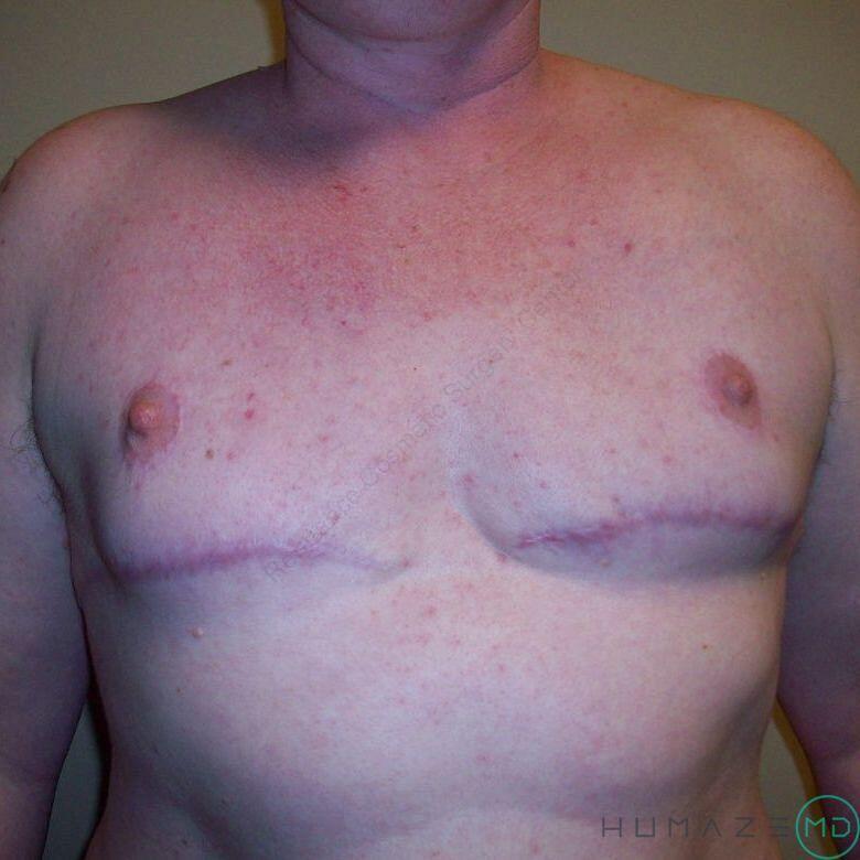 FTM Chest Masculinization Before & After Image