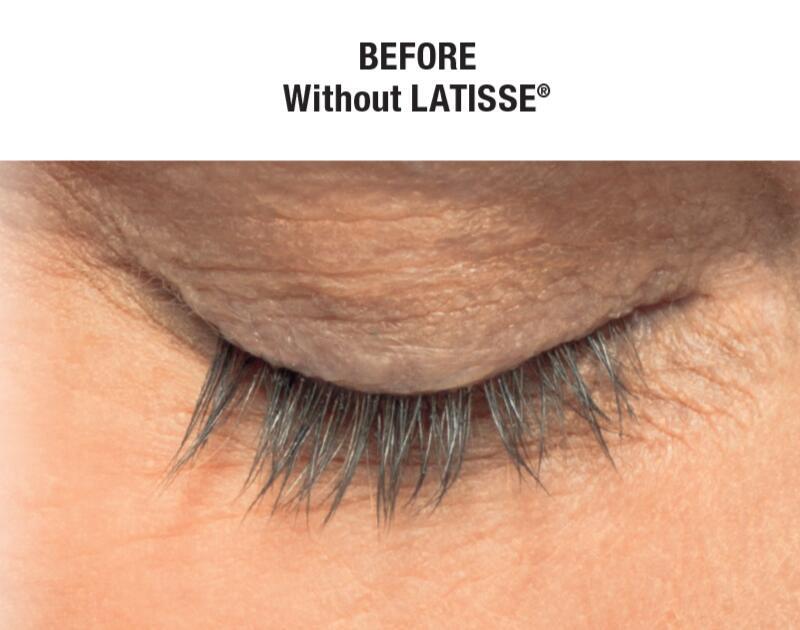 LATISSE Before & After Image