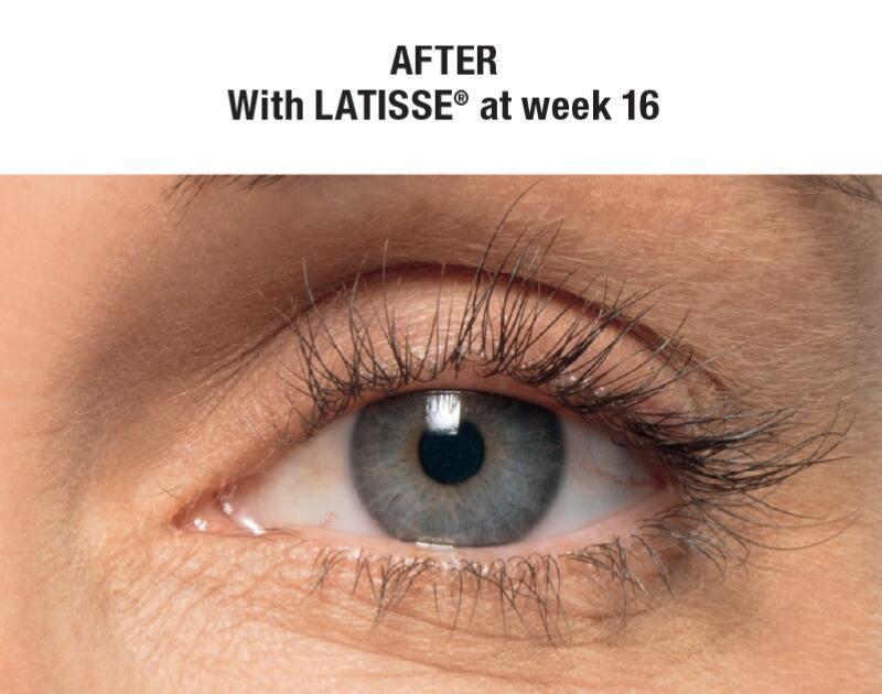 LATISSE Before & After Image